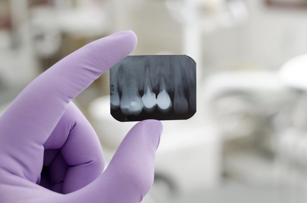 dentist holding dental xray l dentist in wylie tx