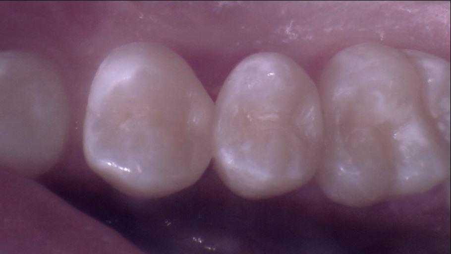 General Dentistry Wylie TX How Can I Prevent Cavities?