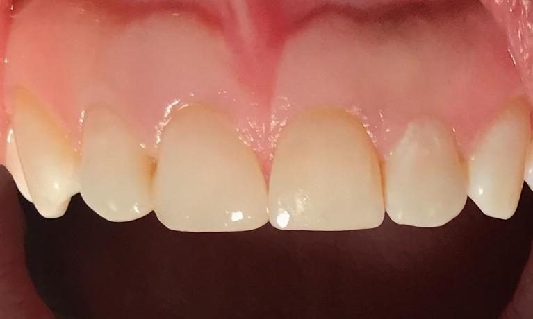Diastema-closure-with-resin-bonding-After-Image
