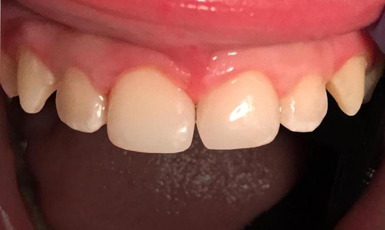 Fractured-teeth-after-an-accident-After-Image