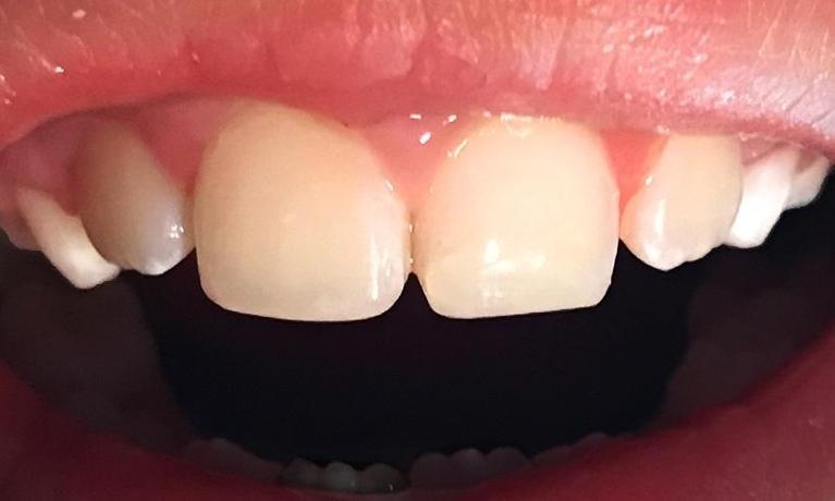 Masking-white-spots-After-Image