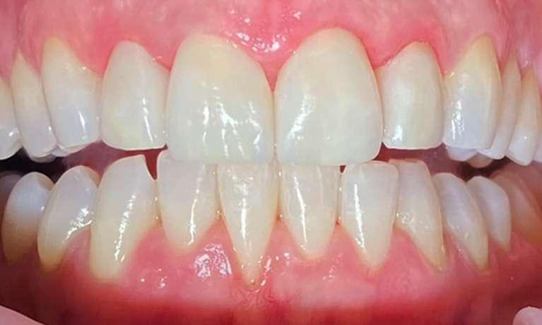 Smile-Makeover-After-Image