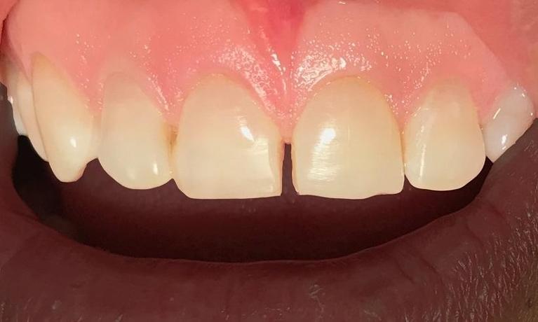 Diastema-closure-with-resin-bonding-Before-Image