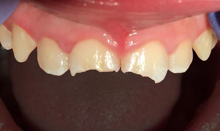 Fractured-teeth-after-an-accident-Before-Image