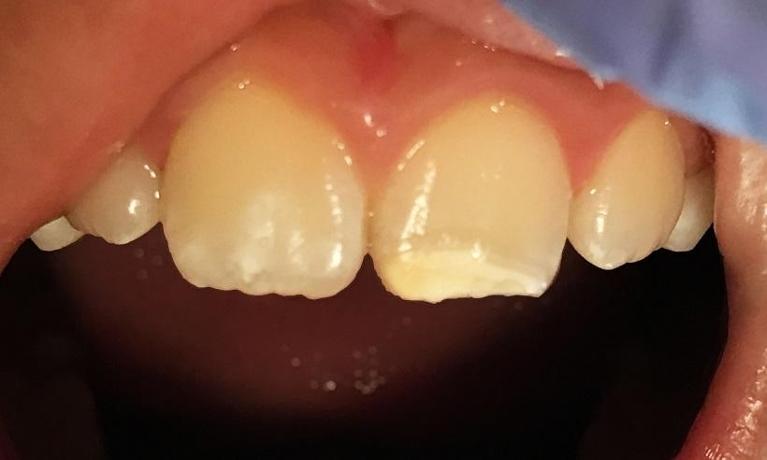 Masking-white-spots-Before-Image