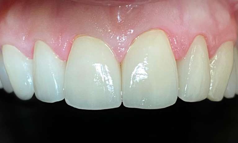 Cosmetic-Crowns-and-Fillings-After-Image