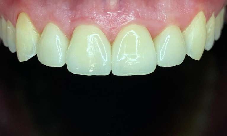 Crowns-and-Veneers-After-Image