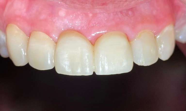 dental bridge 75098