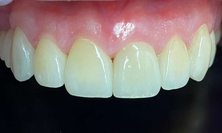 dental crowns | porcelain veneers | 75098 dentist 