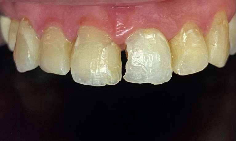 dental crown treatment | wylie texas dentist