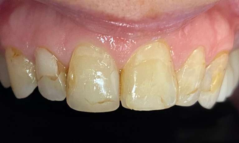 Cosmetic-Crowns-and-Fillings-Before-Image