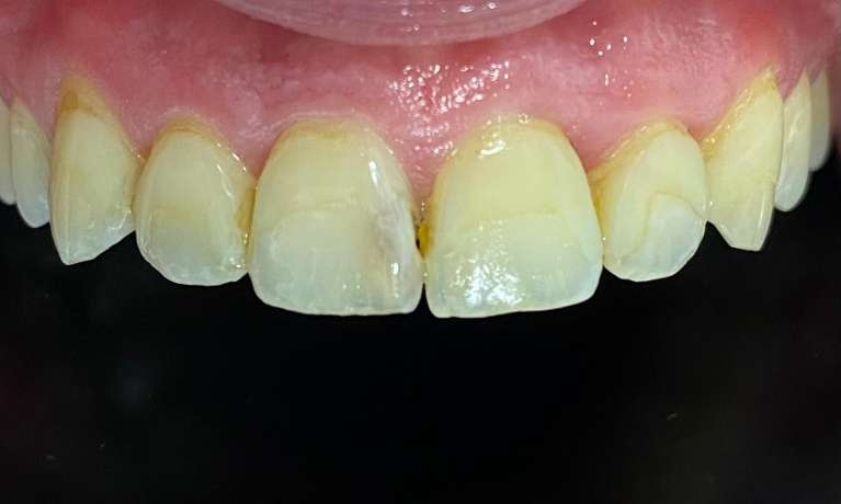 Crowns-and-Veneers-Before-Image