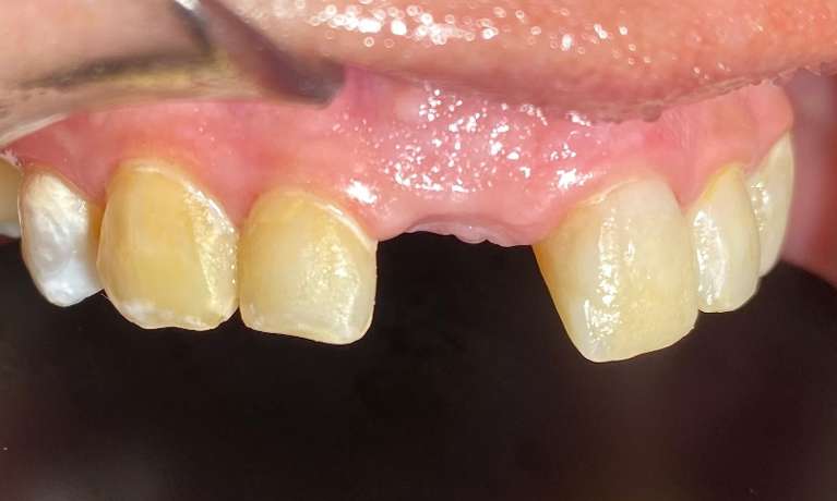 dental bridge dentist wylie texas