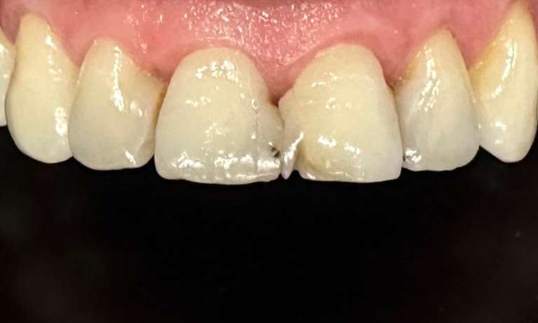 Porcelain-and-ceramic-crowns-Before-Image