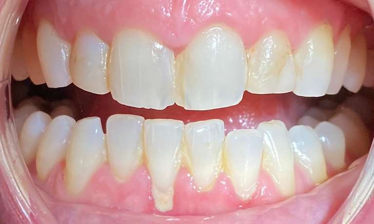 Smile-Makeover-Before-Image
